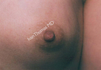 Nipple Surgery