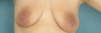 Areola Reduction and Breast Augmentation