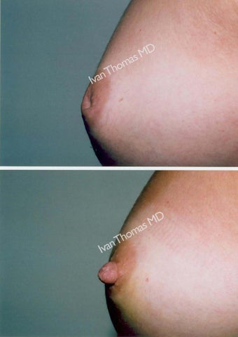 Nipple Surgery