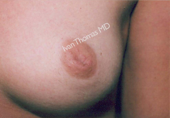 Nipple Surgery