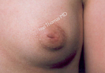 Nipple Surgery