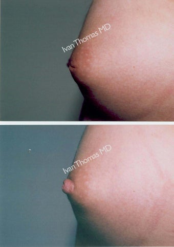Nipple Surgery