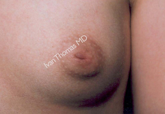 Nipple Surgery