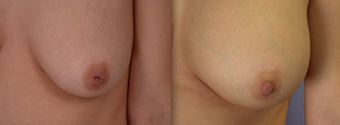 Nipple Surgery