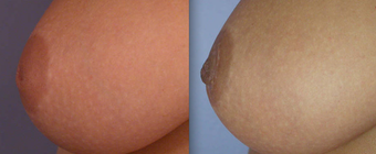 Nipple Surgery