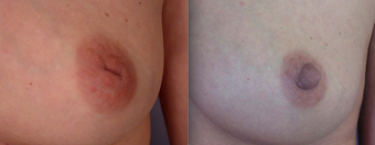 Nipple Surgery