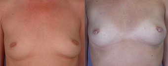 Nipple Surgery