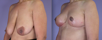Nipple Surgery