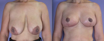 Nipple Surgery