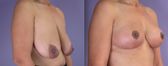 Nipple Surgery