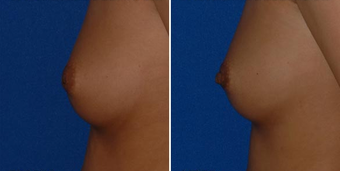 Nipple Surgery