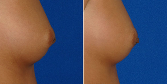 Nipple Surgery