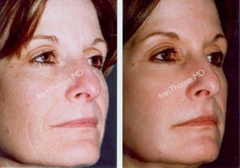 Non-Surgical Face Lift- Exoderm 