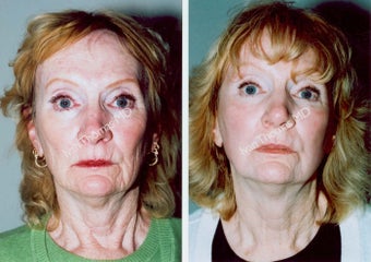 Non-Surgical Face Lift- Exoderm 