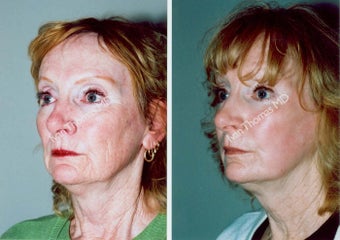 Non-Surgical Face Lift- Exoderm 