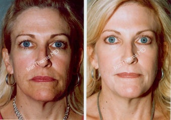 Non-Surgical Face Lift- Exoderm 