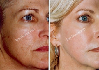 Non-Surgical Face Lift- Exoderm 