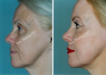 Non-Surgical Face Lift- Exoderm 
