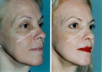 Non-Surgical Face Lift- Exoderm 