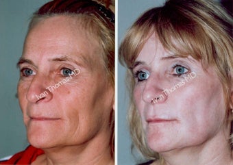 Non-Surgical Face Lift- Exoderm 