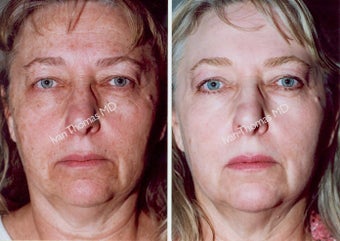 Non-Surgical Face Lift- Exoderm 