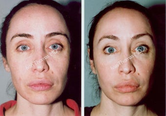 Non-Surgical Face Lift- Exoderm 