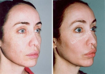 Non-Surgical Face Lift- Exoderm 