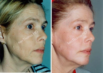 Non-Surgical Face Lift- Exoderm 