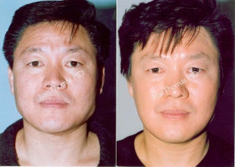 Non-Surgical Face Lift- Exoderm 