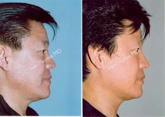 Non-Surgical Face Lift- Exoderm 