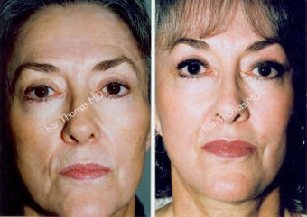 Non-Surgical Face Lift- Exoderm 