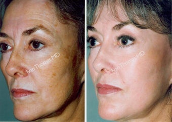 Non-Surgical Face Lift- Exoderm 