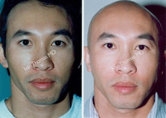 Non-Surgical Face Lift- Exoderm 