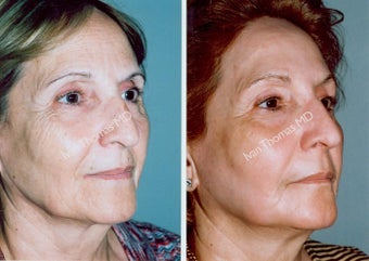 Non-Surgical Face Lift- Exoderm 