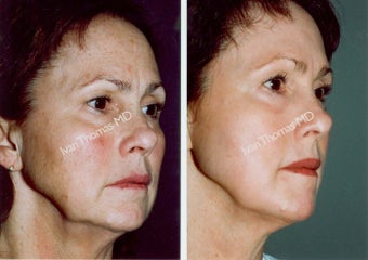 Non-Surgical Face Lift- Exoderm 