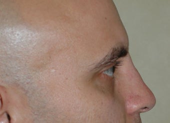 Non-Surgical Rhinoplasty