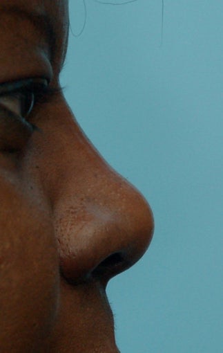 Rhinoplasty, Non-Surgical