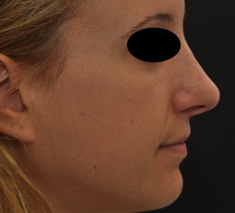 Non-surgical rhinoplasty