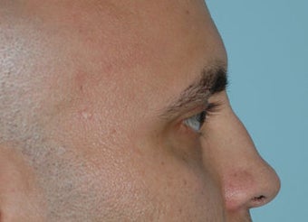 Non-Surgical Rhinoplasty