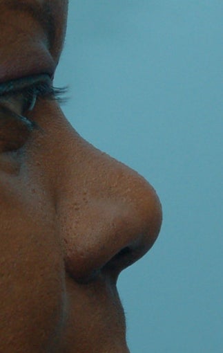 Rhinoplasty, Non-Surgical