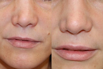 Non-Surgical Rhinoplasty and Lip Augmentation with Silikon-1000