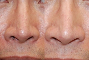 Non-Surgical Rhinoplasty Lowering Nostril Height