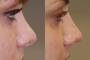 Non-Surgical Rhinoplasty. Profile view.