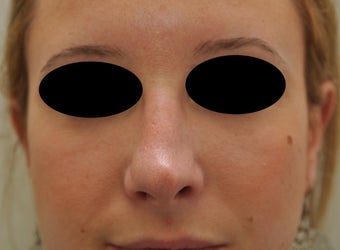 Non-surgical rhinoplasty