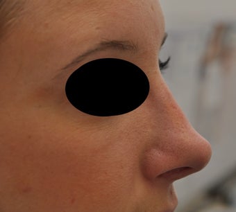 Non-surgical rhinoplasty