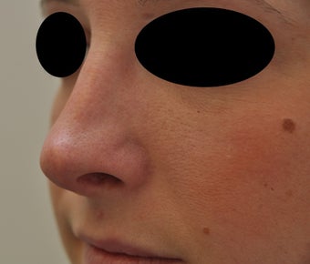 Non-surgical rhinoplasty