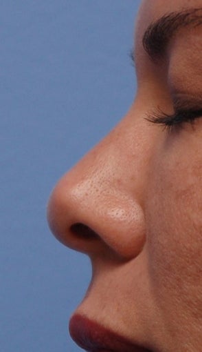 Non-Surgical Rhinoplasty