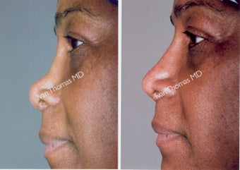 Non-Surgical Rhinoplasty
