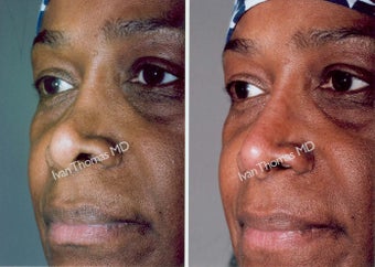 Non Surgical Rhinoplasty