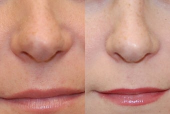 Non-Surgical Rhinoplasty using Silikon-1000
